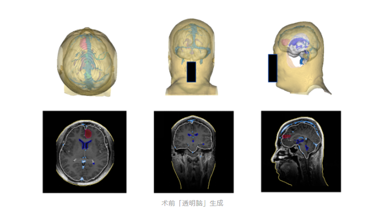 北京协和医院联合腾讯 AI Lab 发布手术导航系统,可一键