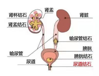 碎石后尿道疼痛正常吗(结石碎石后尿道疼正常吗)