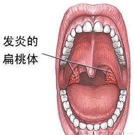 包含成年人扁桃体发炎低烧多久能自愈的词条