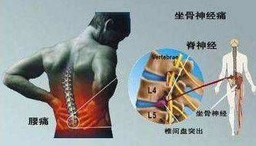 腰部神经在哪(腰椎压迫神经会引起腹部疼吗)