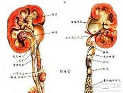 肾脏积液看哪个科的简单介绍