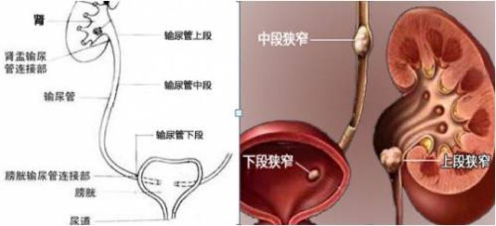 泌尿系统哪里长结石(女性泌尿系统结石的早期症状)