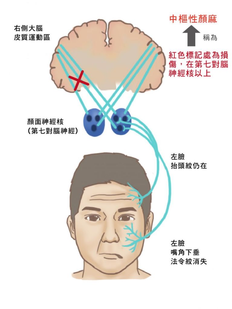 面神经炎早期怎么治(面神经炎早期最主要的治疗措施)