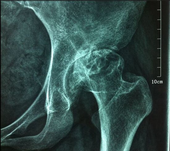 股骨头内部图片视频(股骨头的正确位置图片)