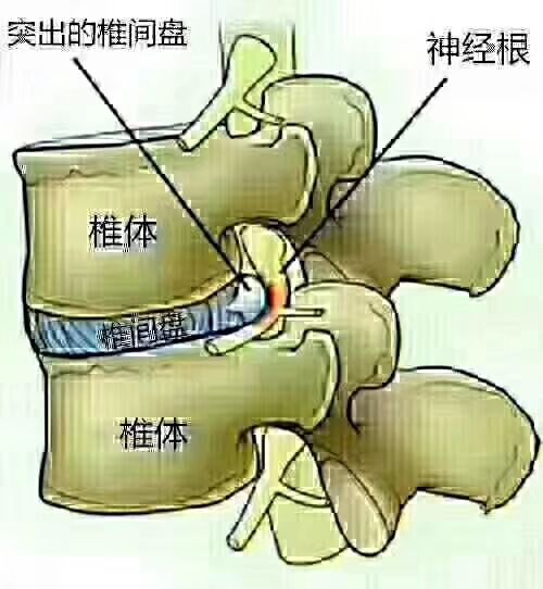 关于哪里都不突出就是腰椎间盘突出的信息