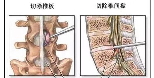 腰椎间盘突出怎样治最好呢(倪萍腰椎间盘突出怎样治好的)