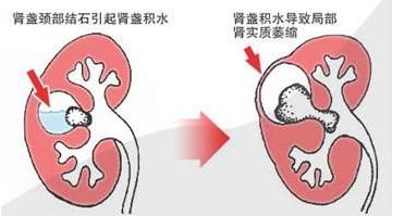 包含尿结石碎石一般多少钱一颗的词条