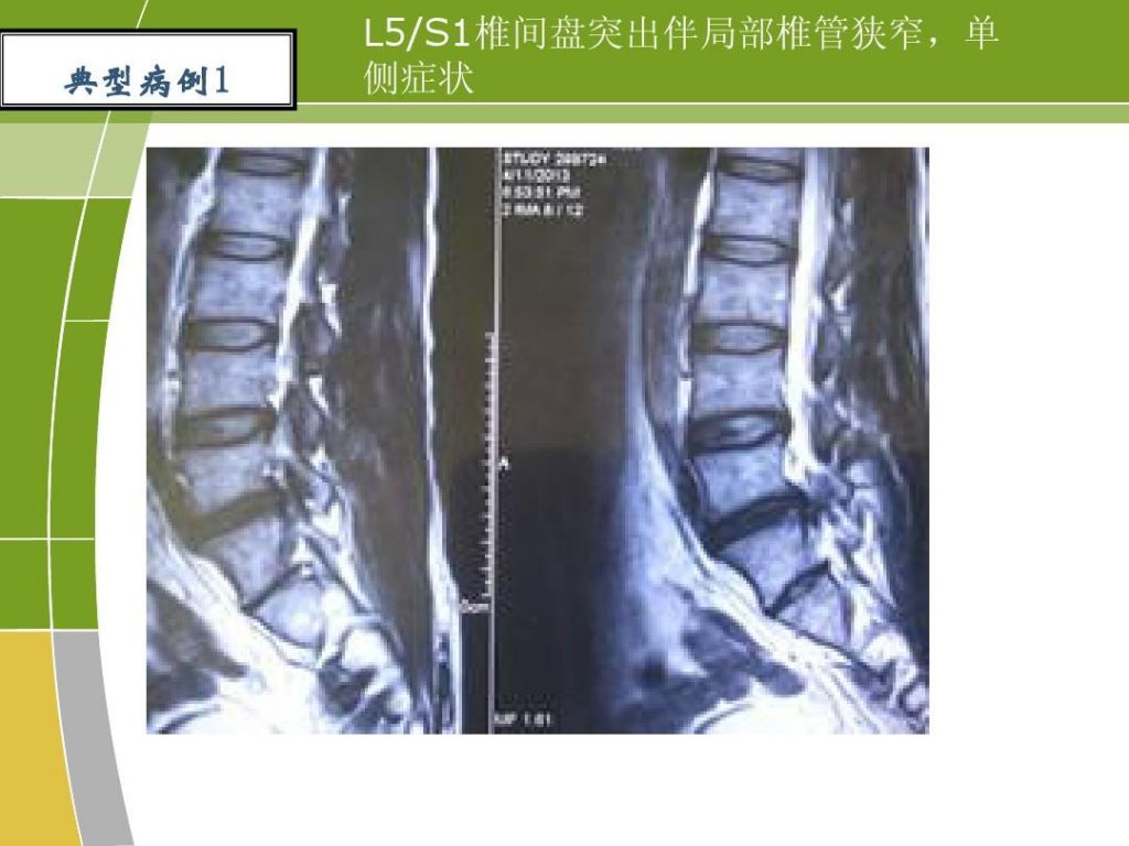 腰椎1一3(腰椎1一3节囊肿4一5节膨出会导致脚麻脚趾疼吗)