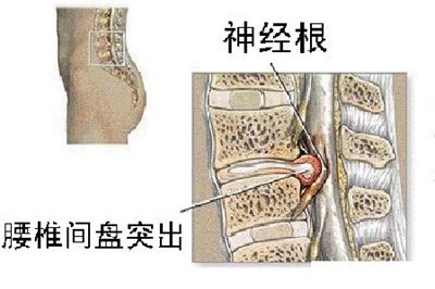 包含腰间盘突出能治好腰椎间盘突出吗的词条