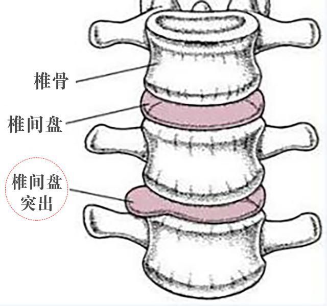 包含腰间盘突出能治好腰椎间盘突出吗的词条