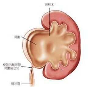 包含成年人肾积水还有30%严重吗的词条