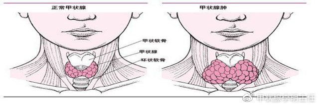 甲状腺炎最明显眼睛突出的症状(桥本氏甲状腺炎会引起眼睛突出吗)