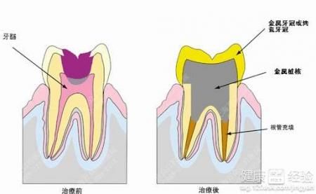 牙髓炎在哪(牙髓炎晚期症状图片)