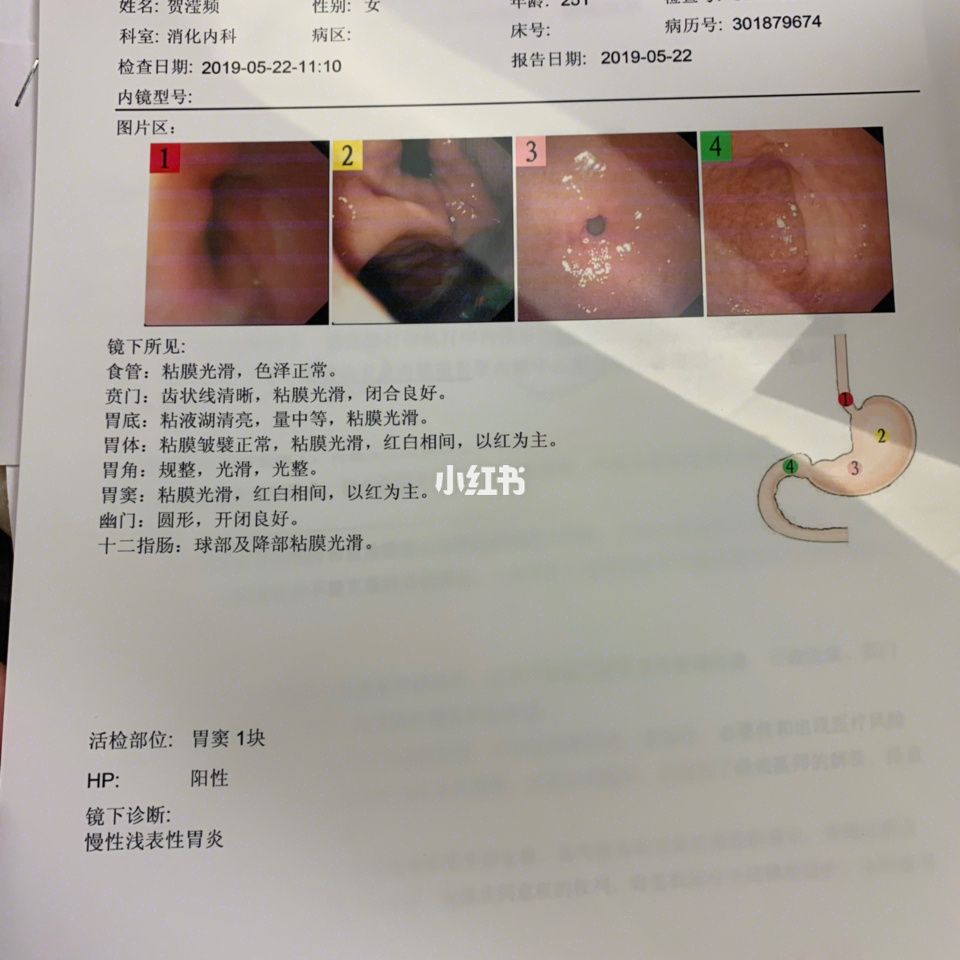 检查幽门螺旋杆菌检查结果(幽门螺旋杆菌检查结果怎么看)