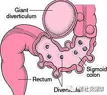 手触左下腹部疼(左下腹部按压疼痛的原因)