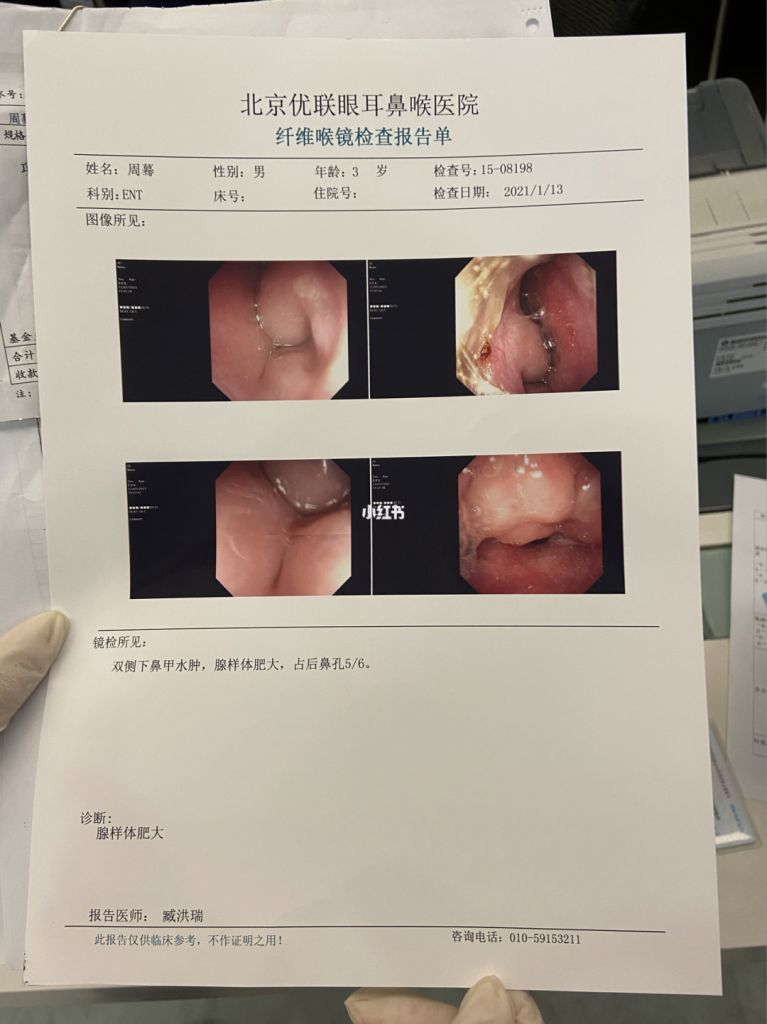 腺样体肥大中度必须手术吗(小孩腺样体肥大中度一定要手术吗)