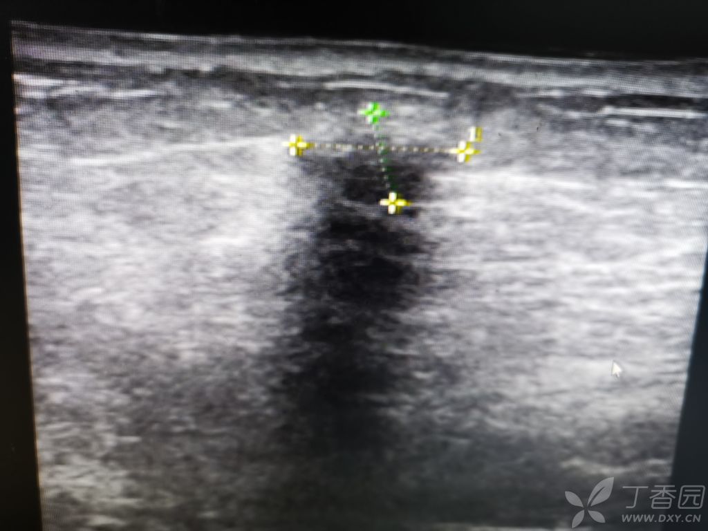 乳腺结节7x4mm三类(乳腺结节7x4mm是几级)