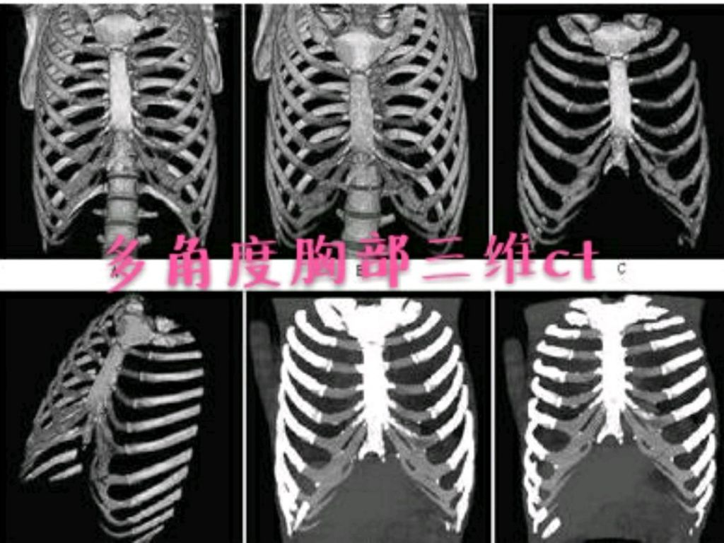 肋角在哪个位置(胸肋在哪个位置图片)