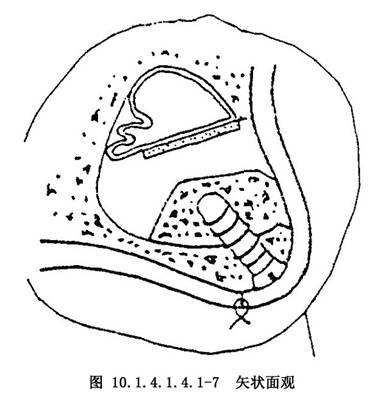 上颌窦在哪(上颌窦在哪个位置)