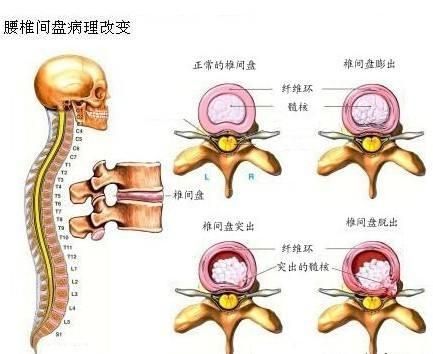 腰骶关节在哪(腰骶关节图片)