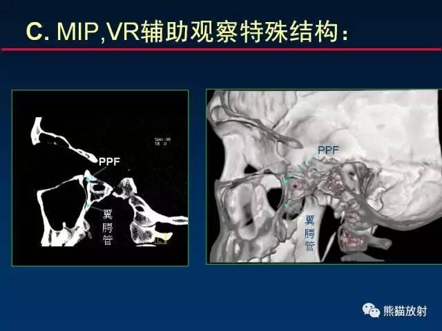 翼管神经在哪(翼管神经阻断术应用时间)