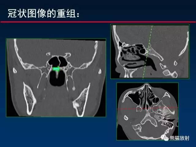 翼管神经在哪(翼管神经阻断术应用时间)