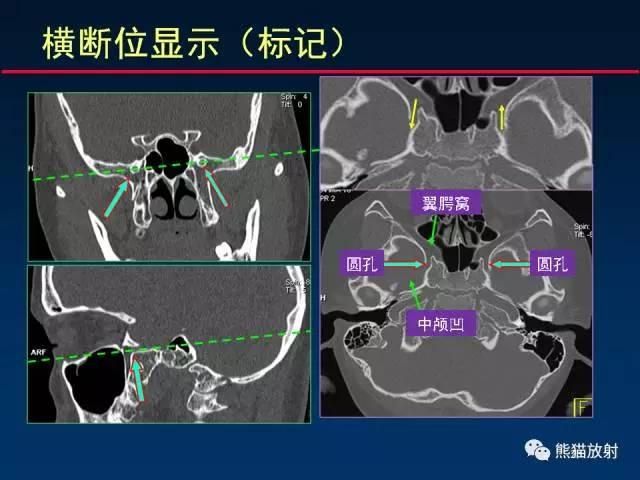 翼管神经在哪(翼管神经阻断术应用时间)