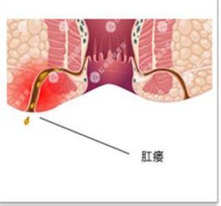 肛瘘长在哪(肛瘘长啥样)